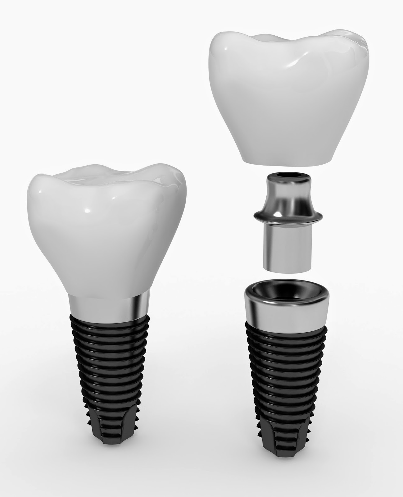 PHỤC HÌNH TRÊN IMPLANT
